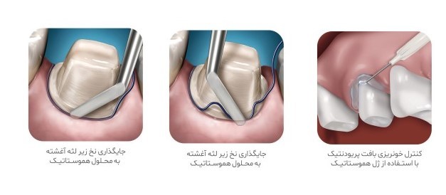 ژل هموستاتیک