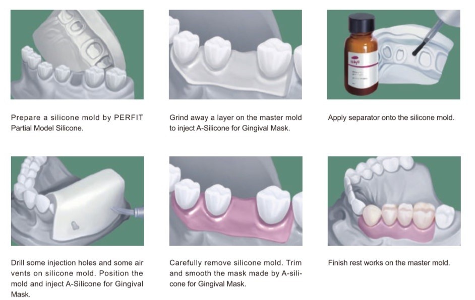 huge-gingival-mask